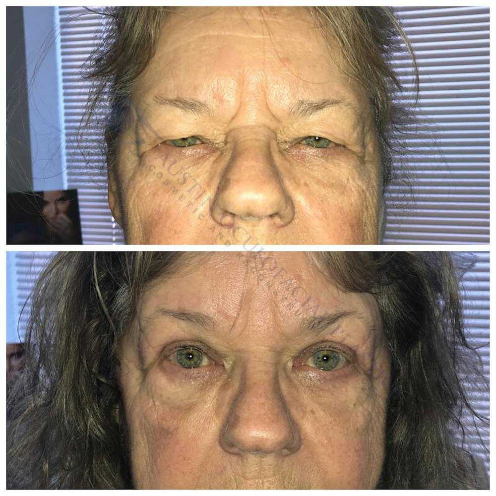 Upper Blepharoplasty Before & After Gallery - Patient 8523671 - Image 2