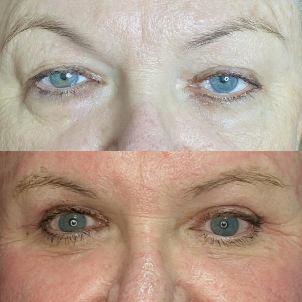 Upper Blepharoplasty Before & After Gallery - Patient 9560675 - Image 1