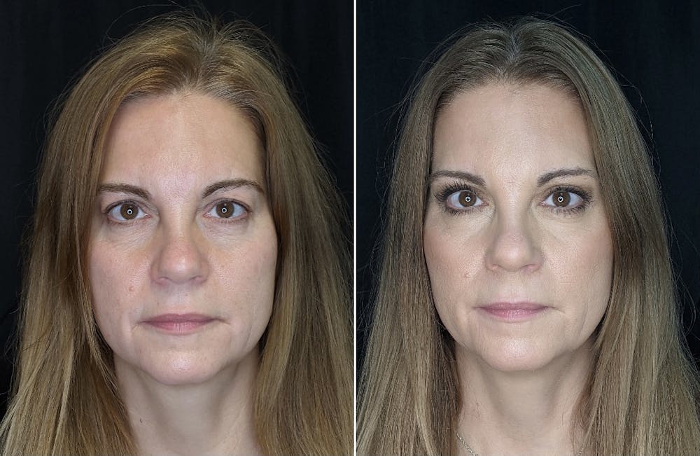 Brow Lift Before & After Gallery - Patient 10602195 - Image 1