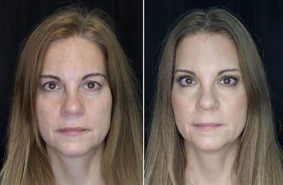Upper Blepharoplasty Before & After Gallery - Patient 10602196 - Image 1