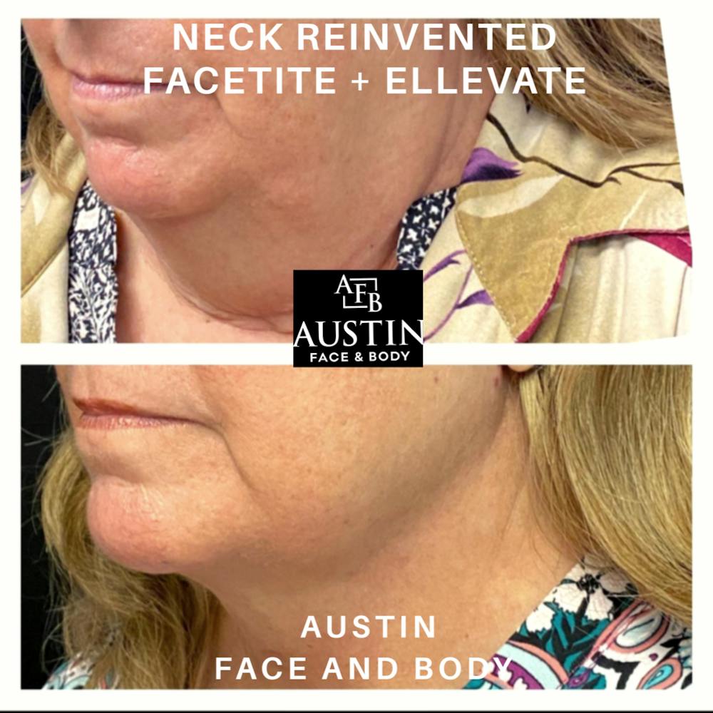 Facetite Before & After Gallery - Patient 10672166 - Image 1