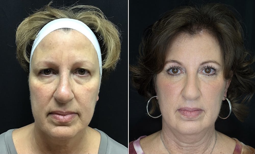 Upper Blepharoplasty Before & After Gallery - Patient 10672173 - Image 1