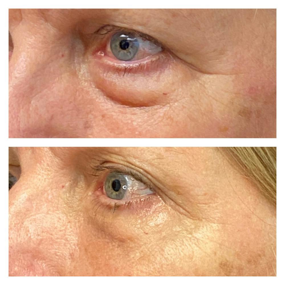 Accutite Before & After Gallery - Patient 13574820 - Image 3