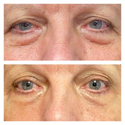 Accutite Before & After Gallery - Patient 13574820 - Image 1