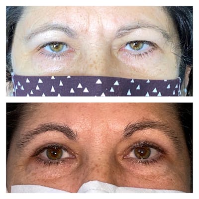 Upper Blepharoplasty Before & After Gallery - Patient 13574824 - Image 1