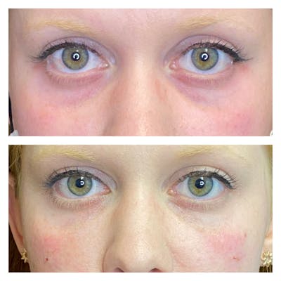 Dermal Fillers Before & After Gallery - Patient 56163521 - Image 1