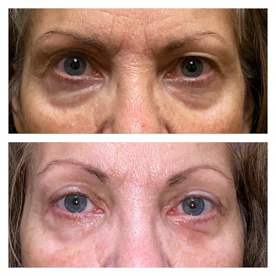 Upper Blepharoplasty Before & After Gallery - Patient 13575108 - Image 1