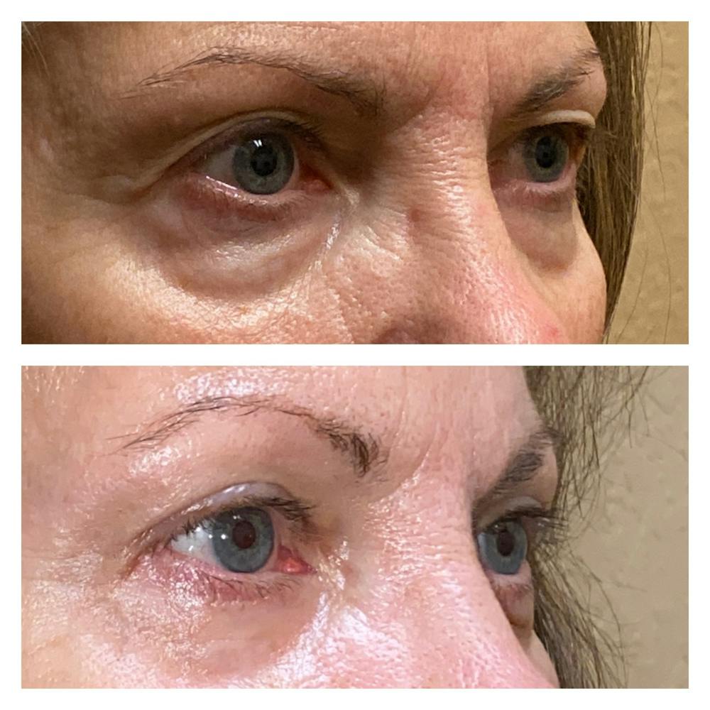 Upper Blepharoplasty Before & After Gallery - Patient 13575108 - Image 2