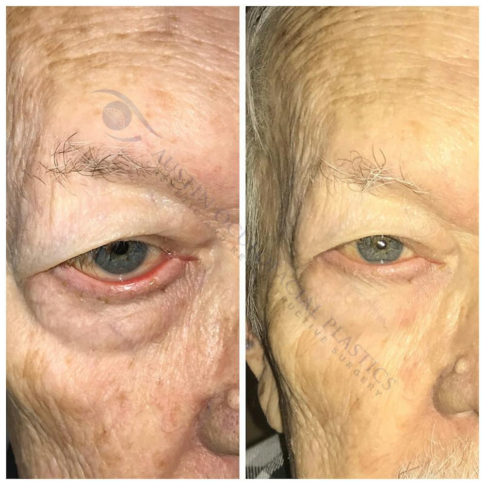 Ectropion Before & After Gallery - Patient 13898536 - Image 1