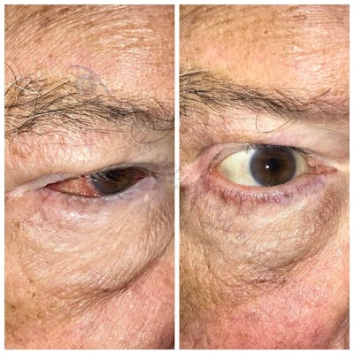 Ectropion Before & After Gallery - Patient 13898537 - Image 1