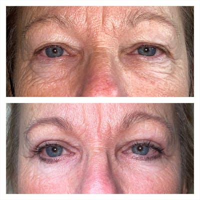 Lower Blepharoplasty Before & After Gallery - Patient 13898604 - Image 1