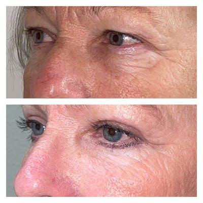 Lower Blepharoplasty Before & After Gallery - Patient 13898604 - Image 2