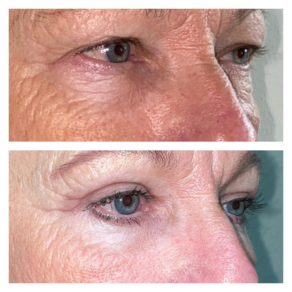 Lower Blepharoplasty Before & After Gallery - Patient 13898604 - Image 3