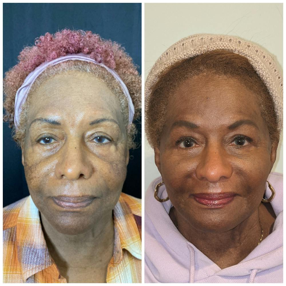 Morpheus8 Before & After Gallery - Patient 15945514 - Image 1