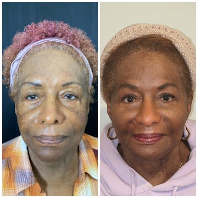 Morpheus8 Before & After Gallery - Patient 15945514 - Image 1