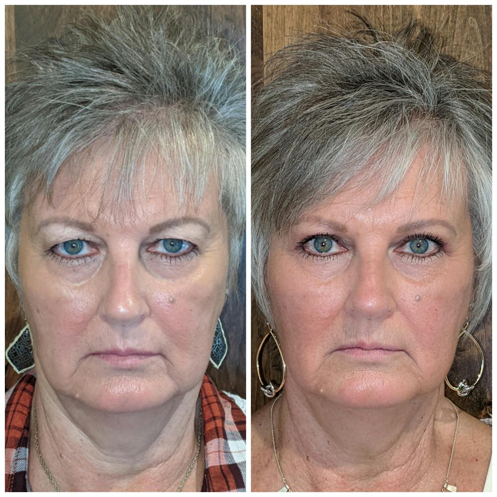 Upper Blepharoplasty Before & After Gallery - Patient 19055038 - Image 1