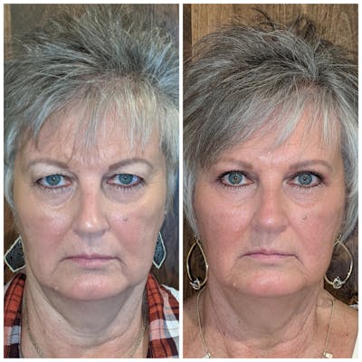 Upper Blepharoplasty Before & After Gallery - Patient 19055038 - Image 1