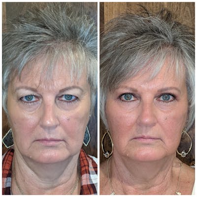 Upper Blepharoplasty Before & After Gallery - Patient 19055038 - Image 1