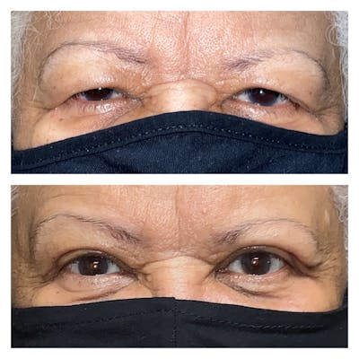 Upper Blepharoplasty Before & After Gallery - Patient 20904243 - Image 1