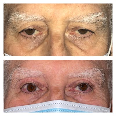 Upper Blepharoplasty Before & After Gallery - Patient 20904244 - Image 1