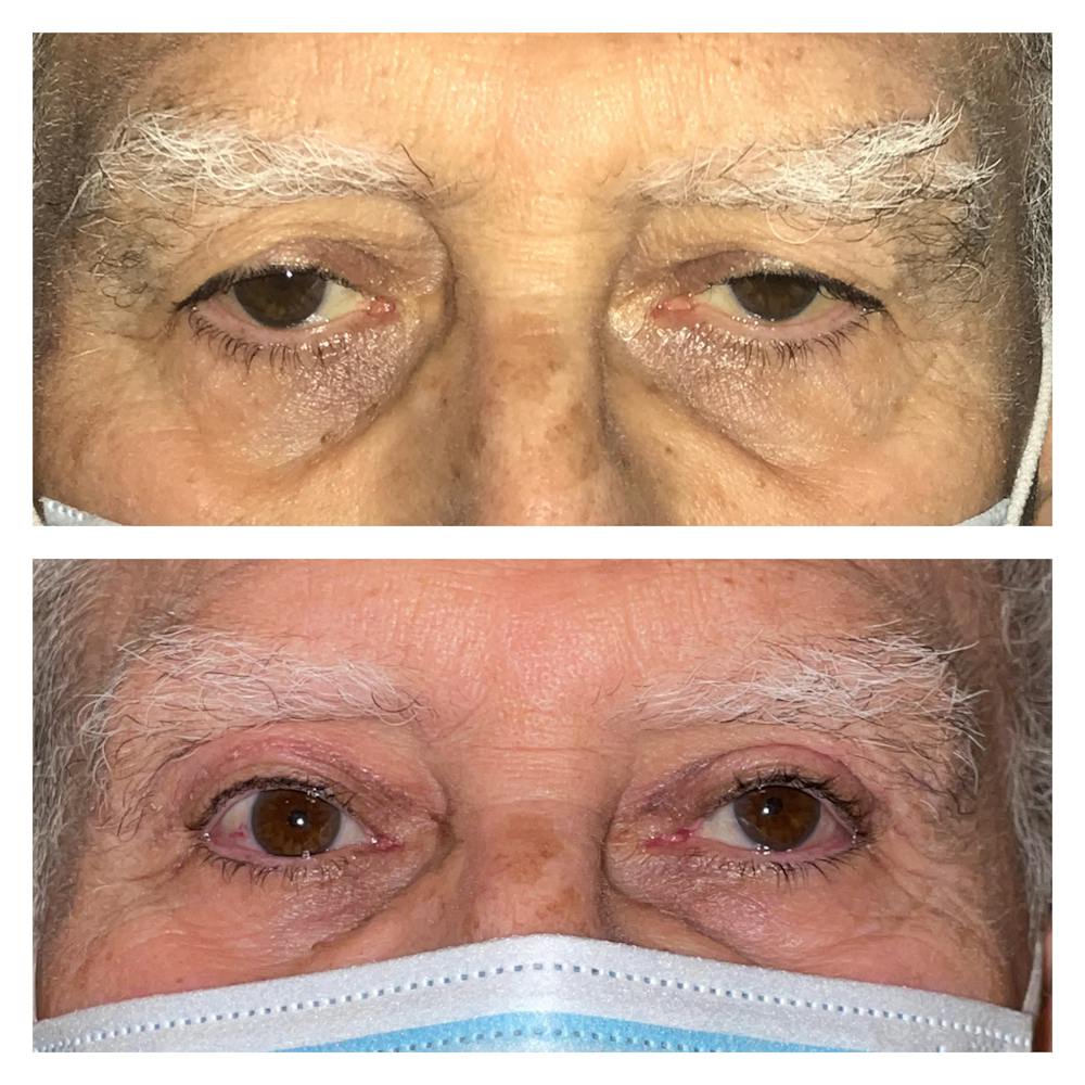 Upper Blepharoplasty Before & After Gallery - Patient 20904244 - Image 1