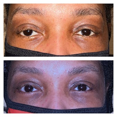 Ptosis Before & After Gallery - Patient 20904261 - Image 1