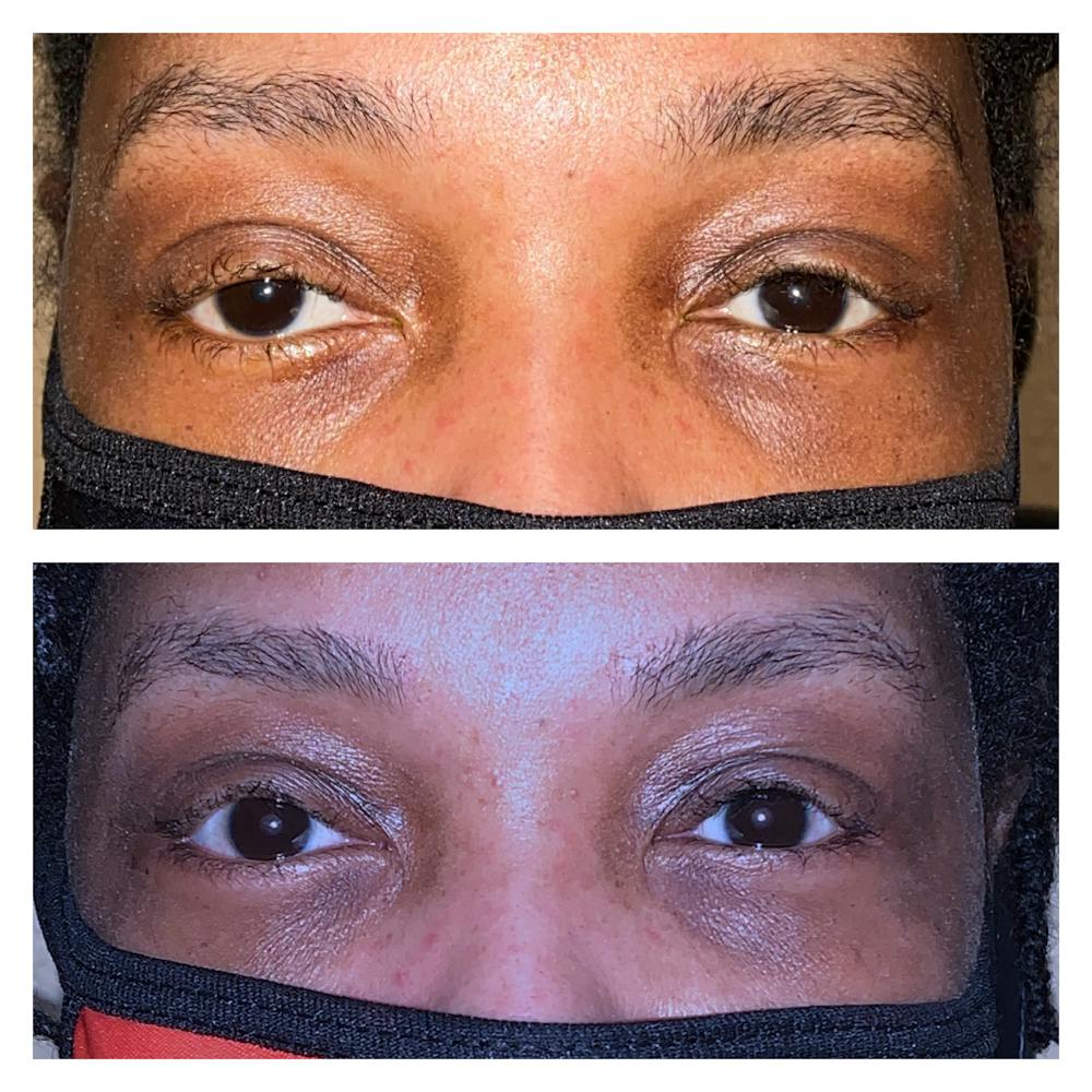Ptosis Before & After Gallery - Patient 20904261 - Image 1