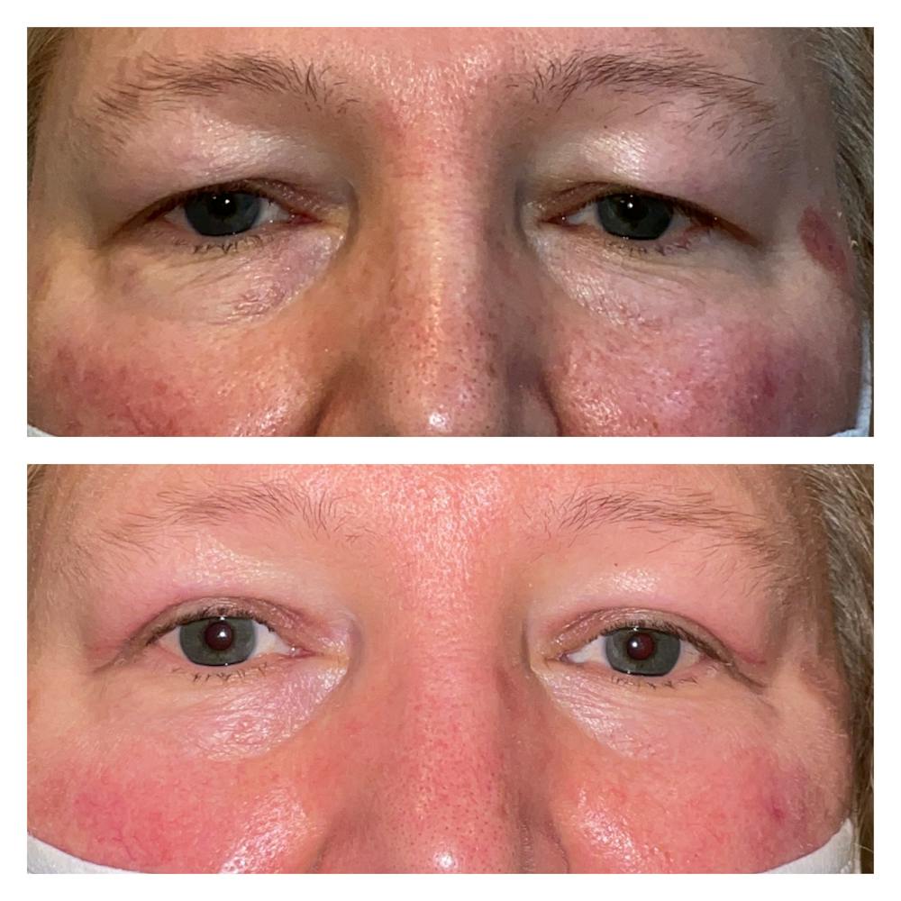 Upper Blepharoplasty Before & After Gallery - Patient 20904552 - Image 1