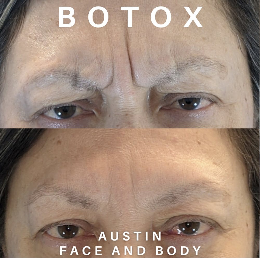 BOTOX Before & After Gallery - Patient 22114434 - Image 1
