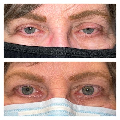 Ptosis Before & After Gallery - Patient 24987066 - Image 1