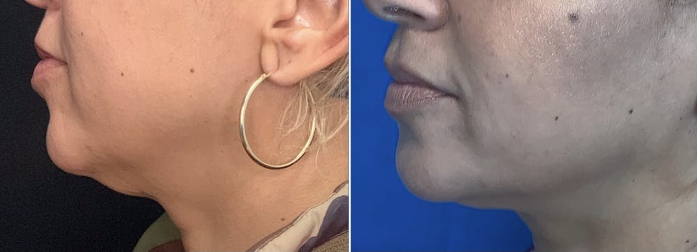 Evoke Radiofrequency Before & After Gallery - Patient 26211896 - Image 1