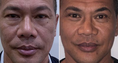 Upper Blepharoplasty Before & After Gallery - Patient 30343087 - Image 2
