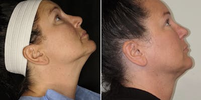 Facetite Before & After Gallery - Patient 30343098 - Image 1