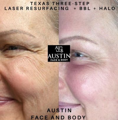 Texas Three Step Before & After Gallery - Patient 35778759 - Image 1