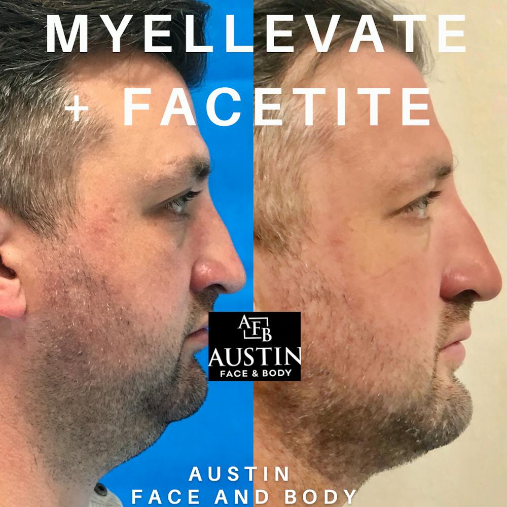 Facetite Before & After Gallery - Patient 38290346 - Image 1