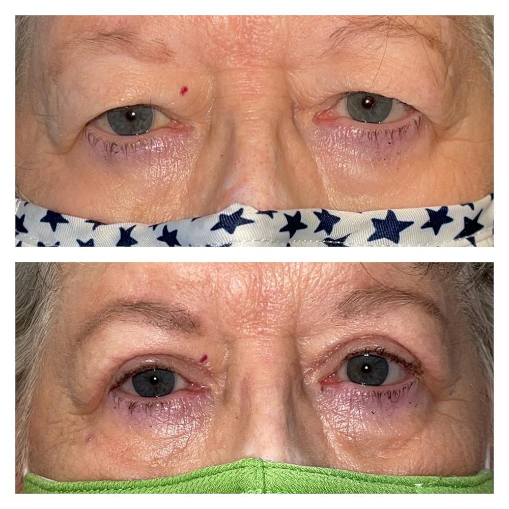 Upper Blepharoplasty Before & After Gallery - Patient 40628881 - Image 1