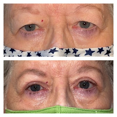 Upper Blepharoplasty Before & After Gallery - Patient 40628881 - Image 1