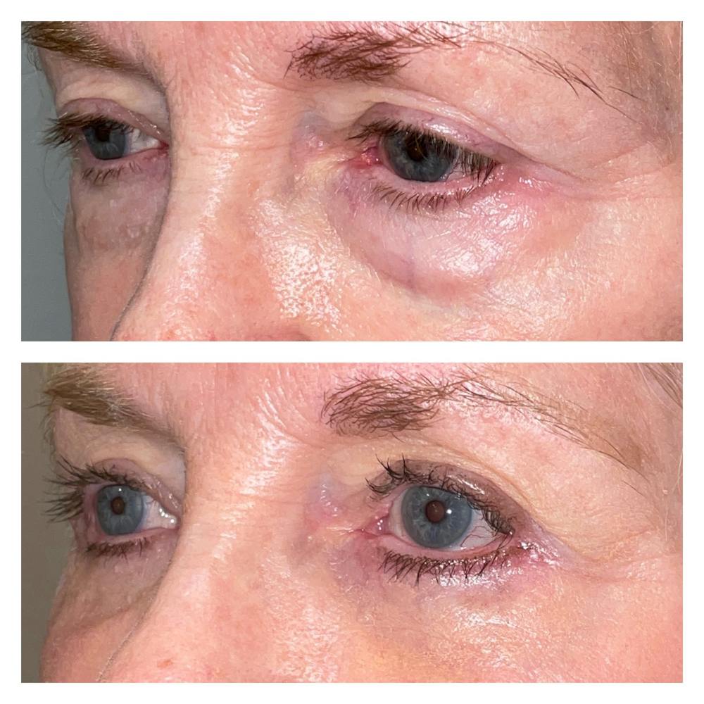 Lower Blepharoplasty Before & After Gallery - Patient 40628915 - Image 2