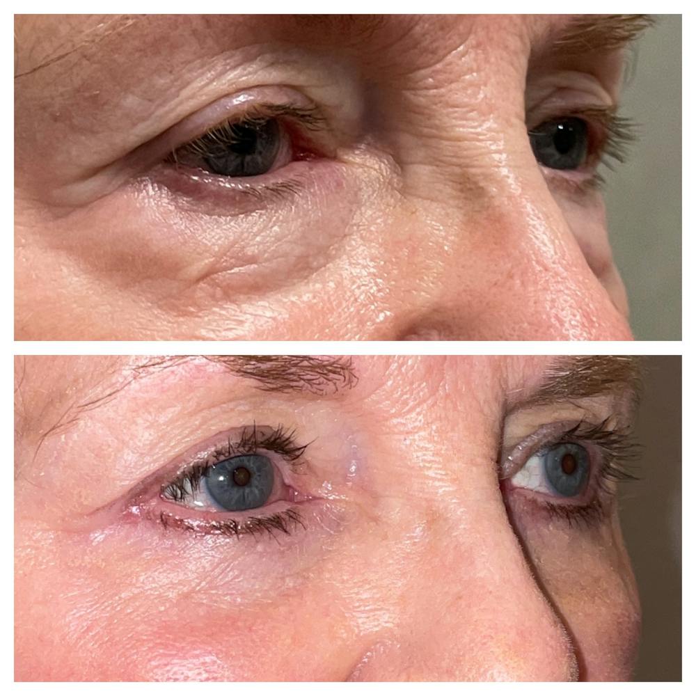 Lower Blepharoplasty Before & After Gallery - Patient 40628915 - Image 3