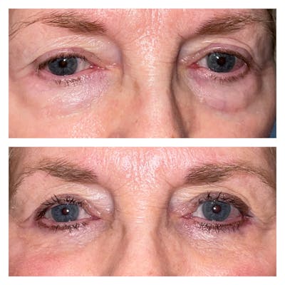 Lower Blepharoplasty Before & After Gallery - Patient 40628915 - Image 1
