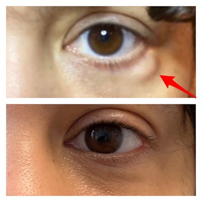 Lower Blepharoplasty Before & After Gallery - Patient 40628959 - Image 1