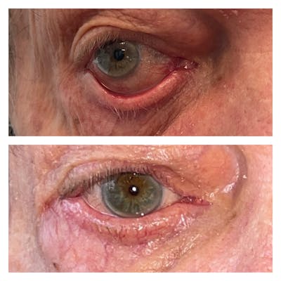 Ectropion Before & After Gallery - Patient 40628976 - Image 1