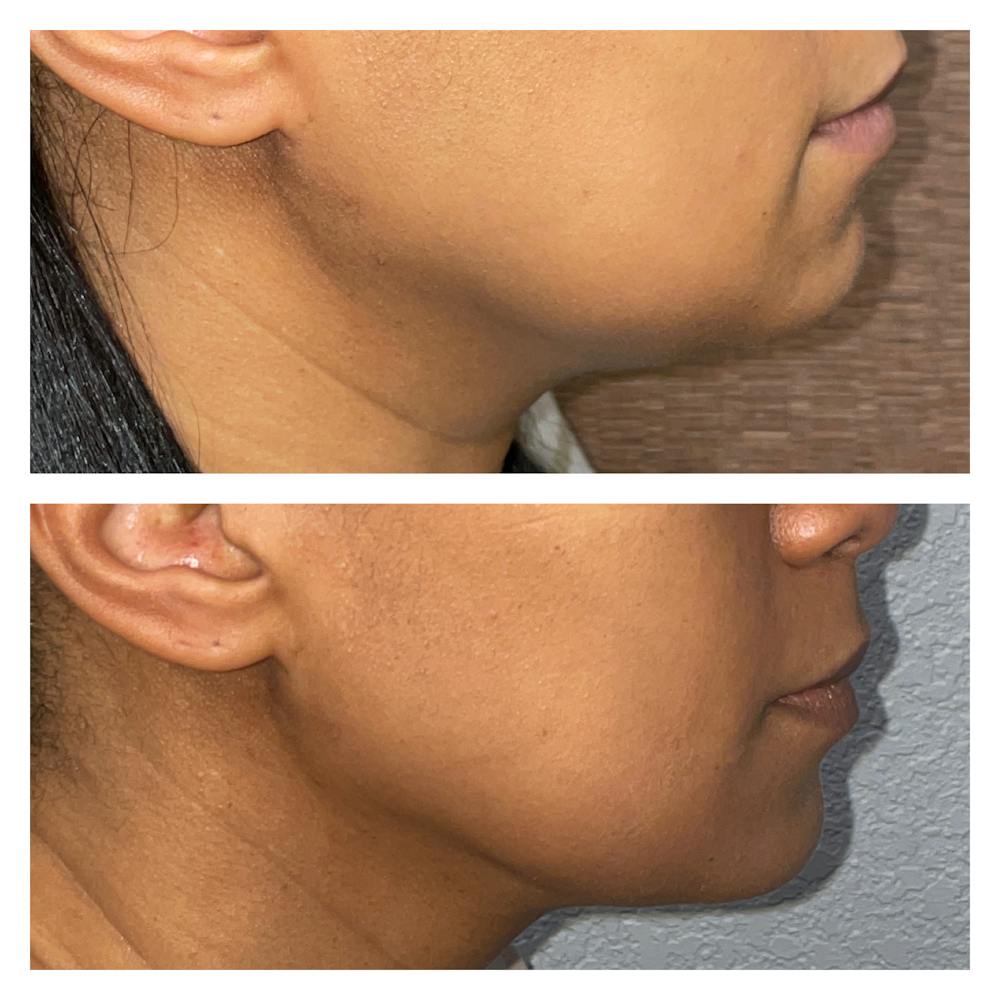 Submental Liposuction Before & After Gallery - Patient 40889849 - Image 2