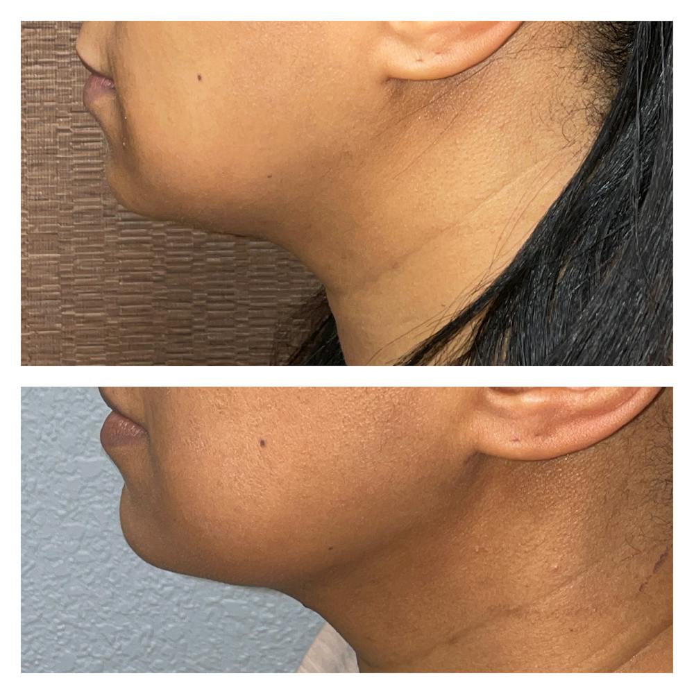 Submental Liposuction Before & After Gallery - Patient 40889849 - Image 1