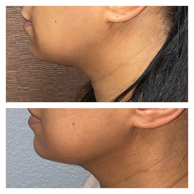 Facetite Before & After Gallery - Patient 40889795 - Image 1