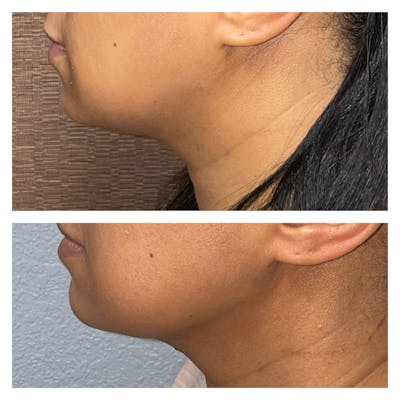 Submental Liposuction Before & After Gallery - Patient 40889849 - Image 1