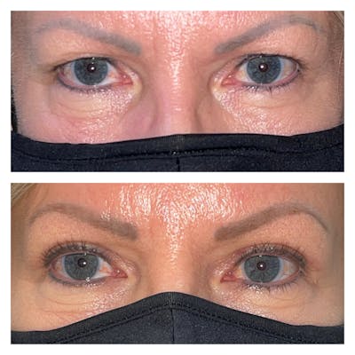 Upper Blepharoplasty Before & After Gallery - Patient 40889899 - Image 1