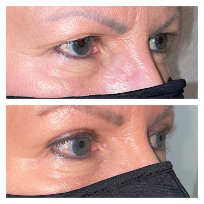 Upper Blepharoplasty Before & After Gallery - Patient 40889899 - Image 2