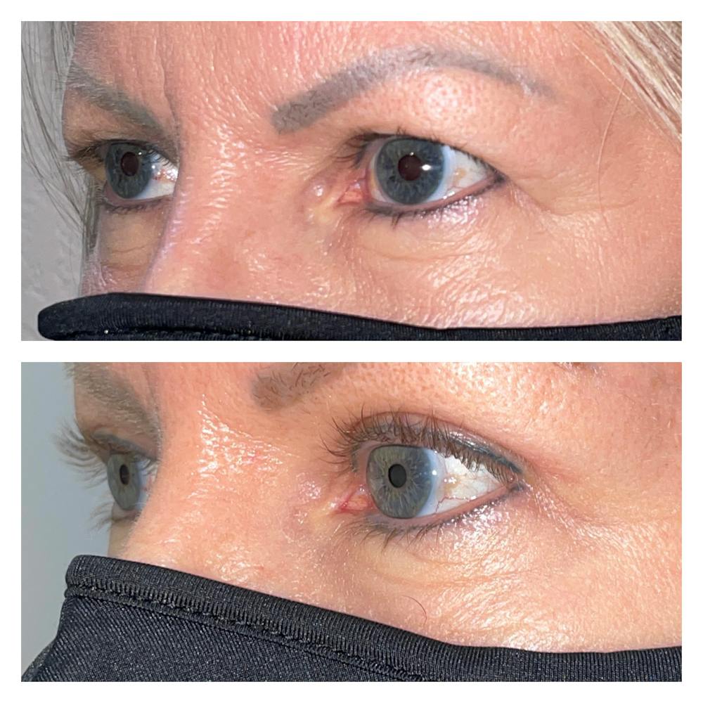 Upper Blepharoplasty Before & After Gallery - Patient 40889899 - Image 3