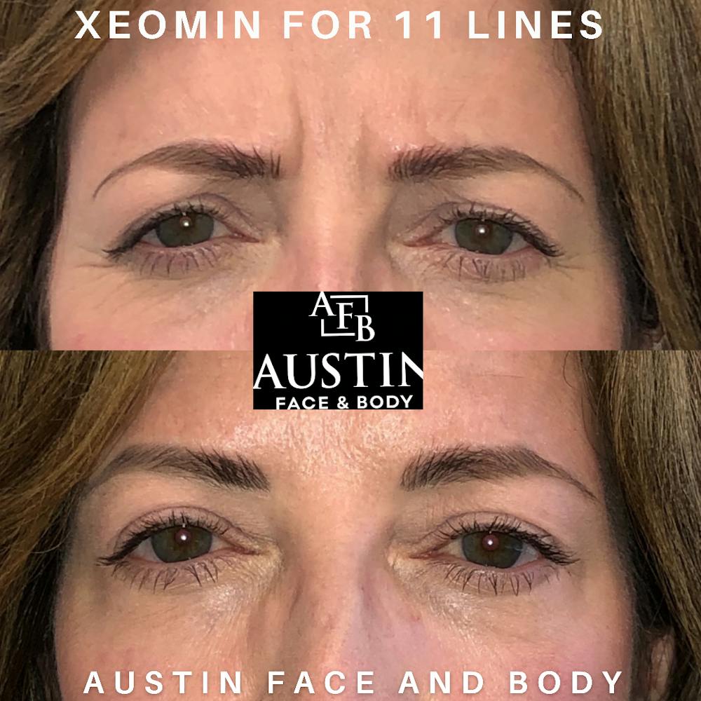 BOTOX Before & After Gallery - Patient 41025430 - Image 1